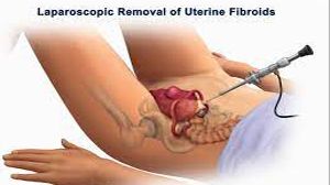 Gynecological laparoscopy at World Laparoscopy Hospital