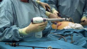 Fluorescence Angiography During Laparoscopic Sleeve Gastrectomy