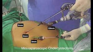 Laparoscopic Management of Perforated Appendicitis