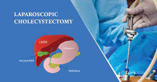 Laparoscopic Cholecystectomy by Dr R K Mishra