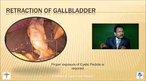 Watch Dr. R.K. Mishra demonstrate Laparoscopic Extracorporeal Square Knot procedure