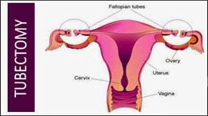 Laparoscopic Ovarian Cystectomy for Dermoid Cyst