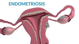 Laparoscopic Surgery for Endometrial Cyst
