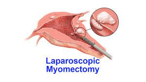 Laparoscopic Myomectomy by Mishra's Knot