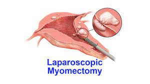Mishra's Knot Ideal for Total Laparoscopic Hysterectomy