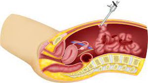 Trocar Injury of Small Intestine during Laparoscopic Surgery