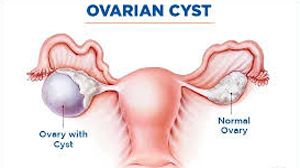 Laparoscopic Ovarian Cystectomy for Dermoid Cyst