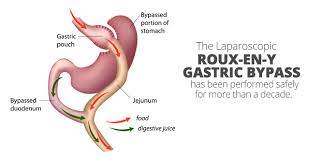 Roux-en-Y Gastric Bypass Weight-Loss Surgery