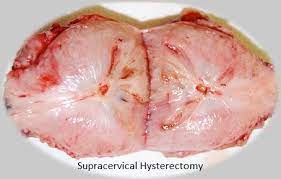 Laparoscopic Supracervical Hysterectomy