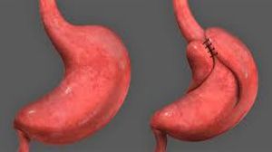 Laparoscopic Cholecystectomy by Dr R K Mishra