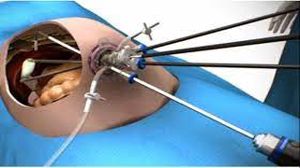 What is the difference in laparoscopic and robotic surgery?