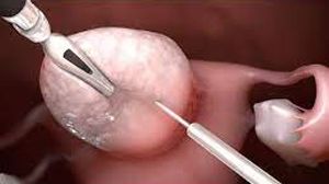 Robotic Bilateral Ovarian Cystectomy