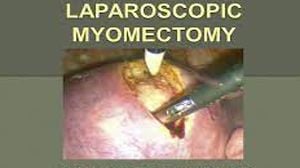 Laparoscopic Myomectomy for Large Intramural Myoma