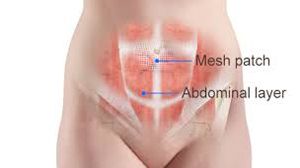 Laparoscopic Incisional Hernia Repair by IPOM Plus Technique and Titanized Mesh