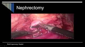 Laparoscopic Nephrectomy