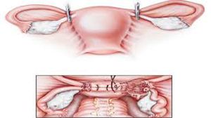 Ruptured Ectopic Pregnancy surgery by Laparoscopy