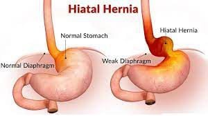 Laparoscopic Repair of Large Hiatus Hernia