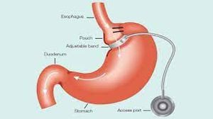 Gastric Banding