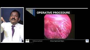 Extracorporeal Knot for Continuous Structure Demonstration by Dr R K Mishra
