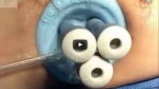 Robotic Reversal of Tubal Sterilization