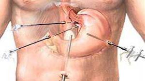 Laparoscopic Dissection Techniques Part 2