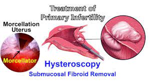 Myomectomy and Dermoid Ovarian Cystectomy