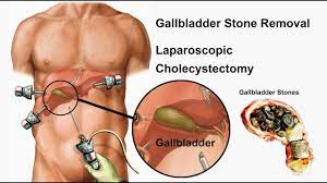 Laparoscopic Cholecystectomy Full HD Video