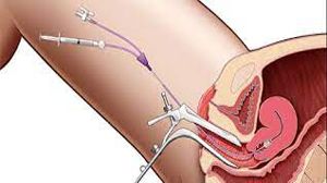 Laparoscopic Mishra's Knot