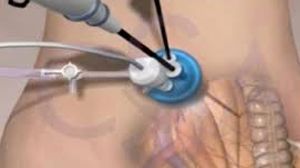 Laparoscopic Surgery for Large Intramural Fibroid Uterus