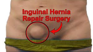 Bilateral Laparoscopic Inguinal Hernia Surgery