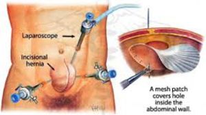 Laparoscopic Repair of Recurrent Incisional Hernia by Prolene Mesh