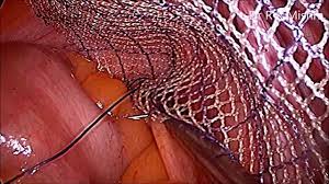 IPOM Laparoscopic Inguinal Hernia Repair