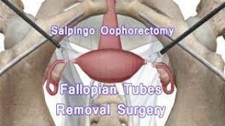Laparoscopic Cholecystectomy, Appendectomy and small Myomectomy in same patient