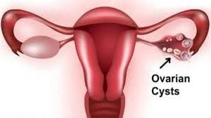 Laparoscopic Surgery for Endometriosis