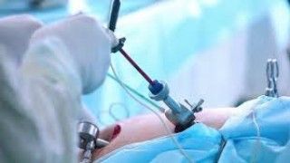 Laparoscopic Management of Ruptured Appendix
