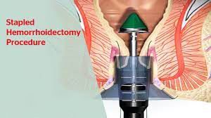 Laparoscopic Management of Ruptured Appendix