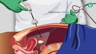 Laparoscopic Hernia Surgery TAPP
