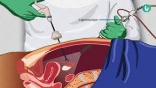 Diagnostic Laparoscopy Lecture by Dr R K Mishra