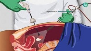 Advanced Precision: Laparoscopic Hernia Repair with Large Sac TAPP Technique