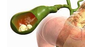 Laparoscopic Fundoplication