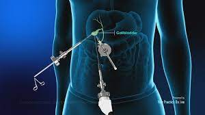 Mishra's Knot - Ideal for Laparoscopic Cholecystectomy