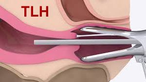 Laparoscopic Hysterectomy with Ureteral Stent Placement