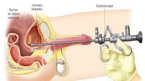 Cystoscopy in Female for Biopsy
