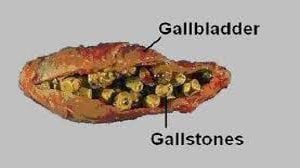 Lap Chole for Gall Stone