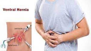 Dr R K Mishra's Lecture on Laparoscopic Repair of Ventral Hernia