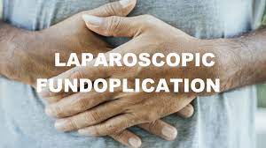 Laparoscopic Scissors