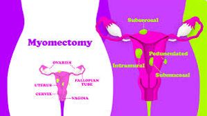 Sacrocolpopexy with hysterectomy using mesh for uterine prolapse repair