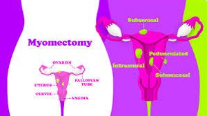 Bilateral Salpingectomy with Appendicectomy - Dr R K Mishra