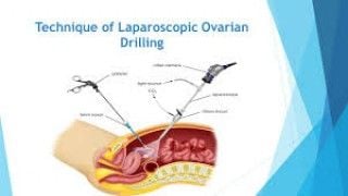 Laparoscopic Ovarian Drilling by Dr. R. K. Mishra