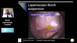 Lecture of Dr R K Mishra on Burch Suspension for stress urinary incontinence